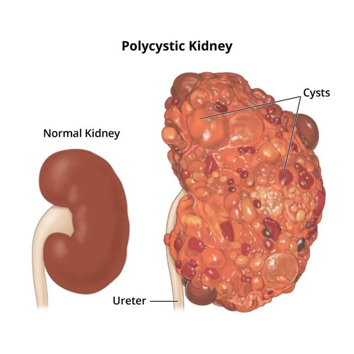 Ati real life kidney disease